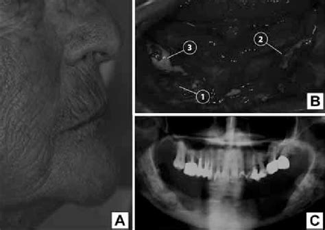 Osteonecrosis Of The Jaw As Induced By Bpns In An Edentulous Patient