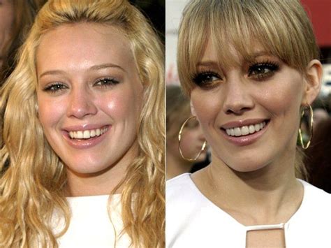 celebrity veneers celebrities with veneers before and after celebrity teeth celebrities