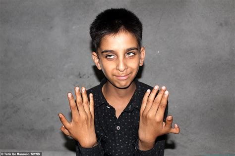 Indian Boy Has An Extra Thumb On Each Hand Daily Mail Online