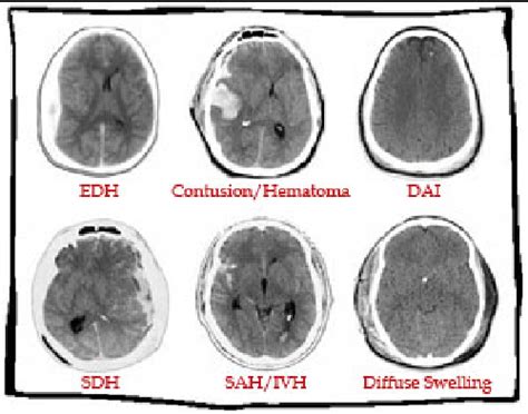 Has Anybody Performed Or Experienced Intracranial Hematoma Removal