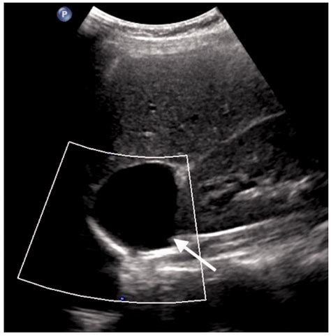 Ultrasound Of The Adrenal Gland In Children Tobi Sm Aderotimi