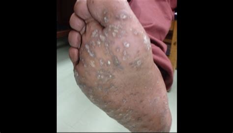 Clinical Challenge Hyperkeratotic Lesions Of The Palms And Soles Mpr