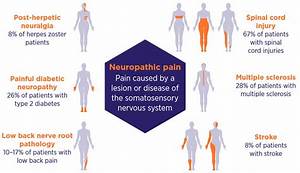 Most Common Types Of Neuropathic And Symptoms Nerve Treatment