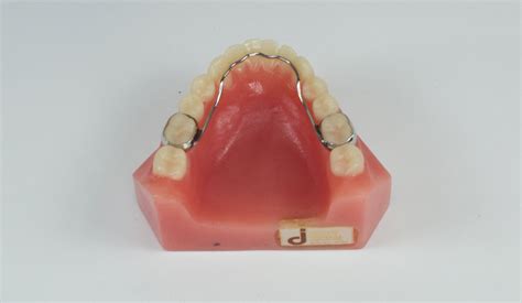 Lingual Arch Johns Dental