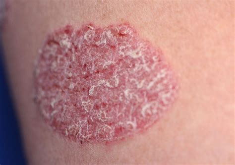What Is Psoriasis And How To Treat It Contour Dermatology