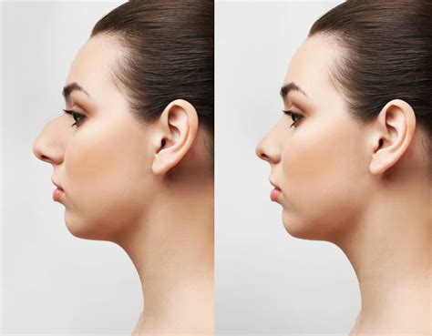 Nose Plastic Surgery Miami Top Rhinoplasty Specialist Dr Carlos Wolf