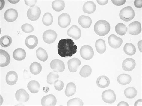 Adult T Cell Leukemia Wikidoc