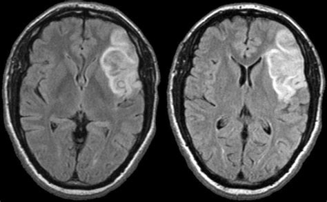 Dr Balaji Anvekar Frcr Ischemic Stroke And Vascular Territories Of Brain