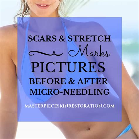 Scar And Stretch Mark Reduction Results Before And After Micro Needling