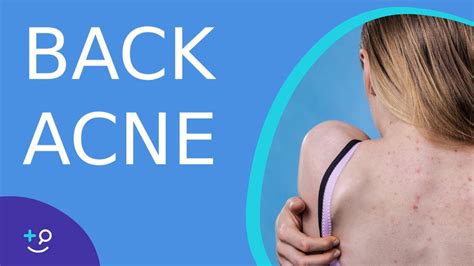 Back Acne Why Do We Get It And How To Treat It Youtube