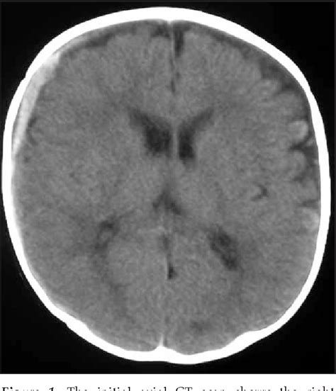 Figure 1 From Rapid Resolution Of Acute Subdural Hematoma And Effects