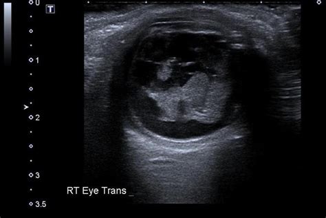 Ocular Ultrasound Core Em