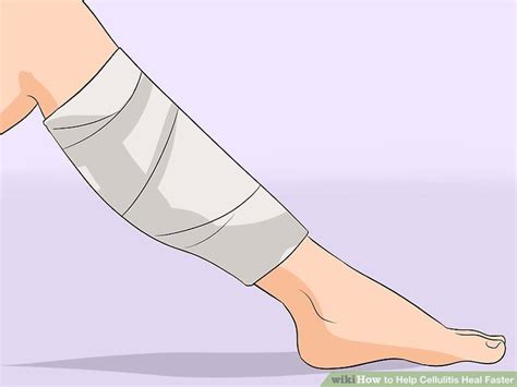 How To Help Cellulitis Heal Faster With Pictures Wikihow