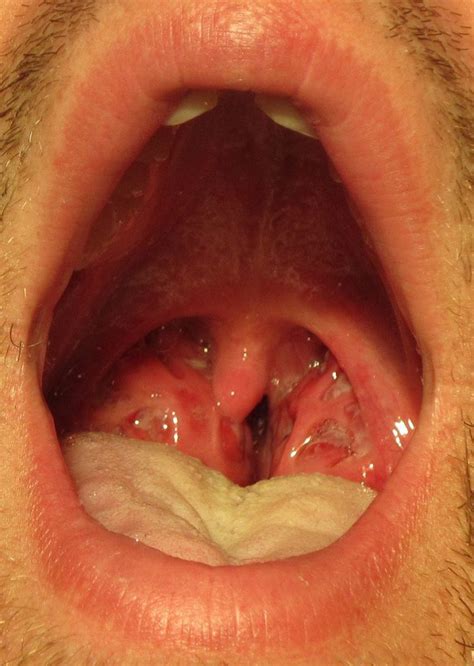 Difference Between Chlamydia And Strep Throat Difference Between