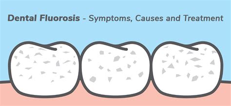 Dental Fluorosis Symptoms Causes And Treatment