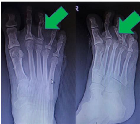 Great Toe Proximal Phalanx Fracture