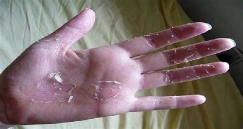 Do You Have Peeling Skin On Your Hands Here Is What You Need To Do