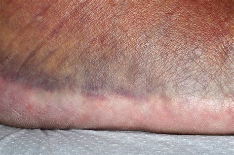 Bruising After An Injury Stock Image C0263427 Science Photo Library