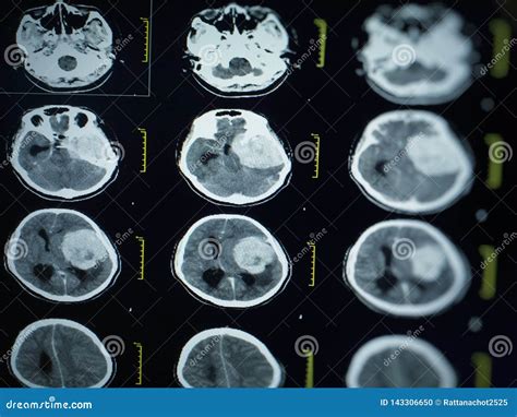 Ct Scan And Mri Of Brain Show Cerebral Infarct Intracerebral