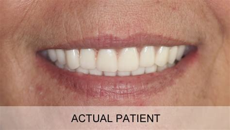 Before And After Photos Tempe Dental Care
