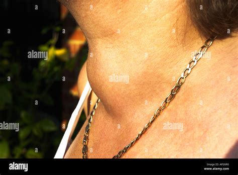 Woman With Thyroid Goitre Stock Photo Alamy
