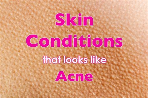 Skin Conditions That Look Like Acne But Arent Skin Conditions