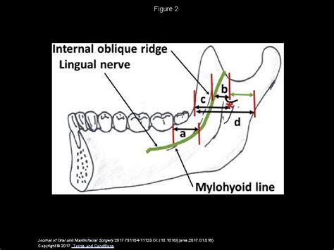 Lingual Nerve Measurements In Cadaveric Dissections Clinical Applications