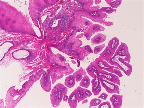 Squamous Papilloma Of The Esophagus Papillary Proliferation Of Mature Download Scientific