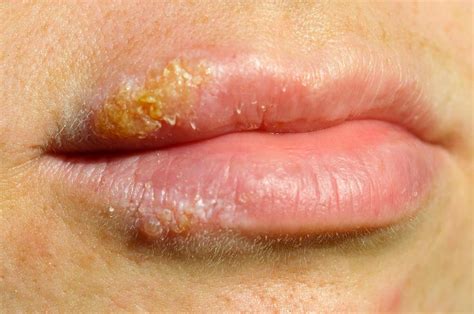 Herpes Inside Mouth Hsv Type 1 Microbiology Medbullets Step 1 Read About Treatment With