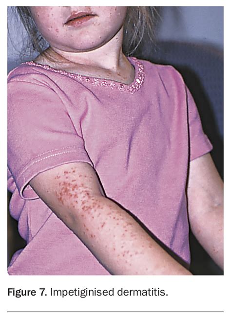Common Skin Problems In Children Managing Atopic Dermatitis Medicine