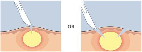 Is It Good To Drain A Cyst Best Drain Photos Primagemorg