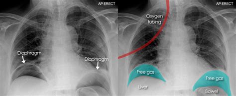 Abdominal X Ray Abnormal Bowel Gas Pattern Free Gaspneumoperitoneum
