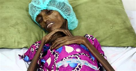 Malnutrition Strikes Yemenis Trapped By Civil War