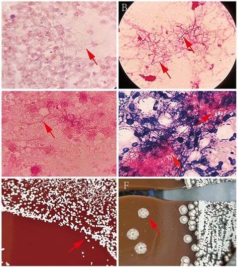 Frontiers Case Report Disseminated Nocardiosis Caused By Nocardia