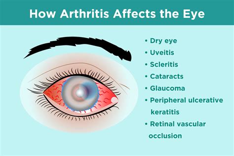 Inflammatory Arthritis and Eye Health: Prevention, Symptoms, Treatment