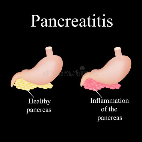Inflammation Of The Pancreas Pancreatitis The Stock Vector