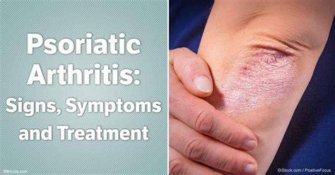 Alcohol Seizures Treatment What Is The Treatment For Psoriatic Arthritis