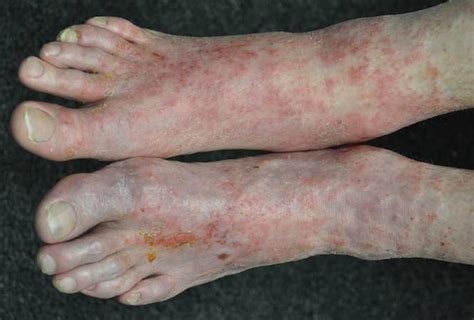 No Relief From Persistent Itchy Rash Clinician Reviews
