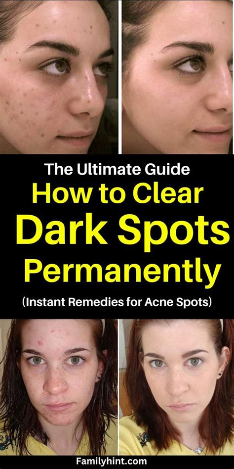 How To Get Rid Of Dark Spots On Face Herbs And Essential Oils Artofit