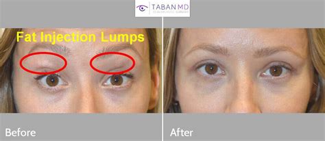 Eyelid And Facial Fat Injection Before And After Gallery Taban Md