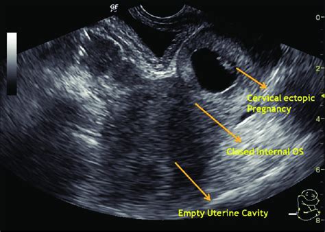 Early Cervical Ectopic Pregnancy With Embryonic Pole Transvaginal My