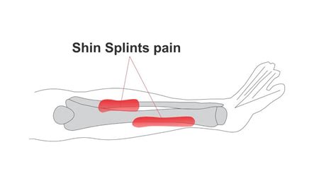 Stop Shin Splints Forever Unbiased Review