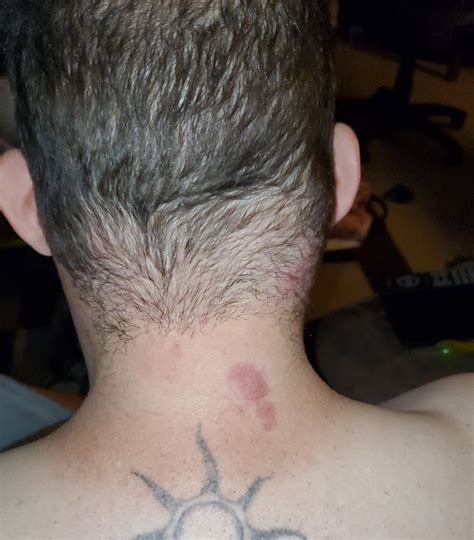 Images Of Shingles On Neck Adolescent Female Presents With Painful