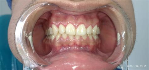 Gingivectomía O Gingivoplastia Centro Odontológico Asiri