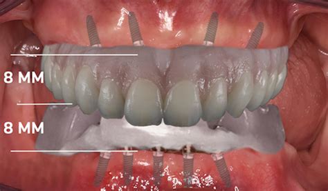 Evaluating Edentulous Patients For Implant Supported Prostheses