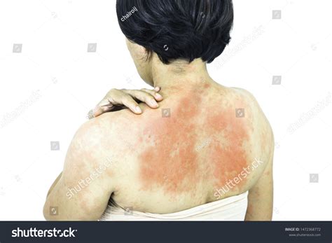 Asian Women Show Skin Redness Rashes Stock Photo 1472368772 Shutterstock