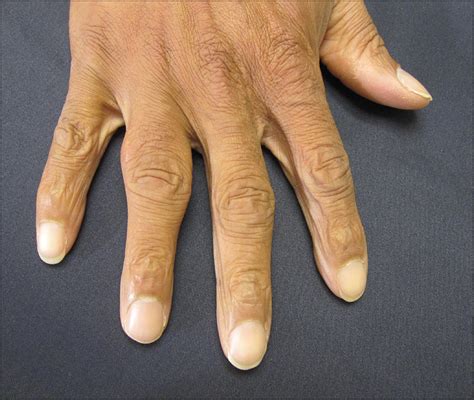 Subcutaneous Nodules On The Fingers—quiz Case Dermatology Jama