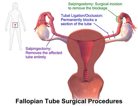 Laparoscopic Salpingectomy