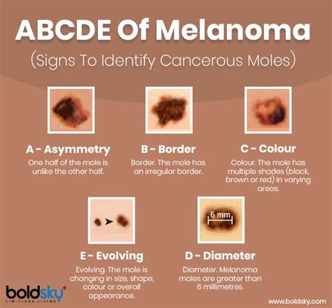 Different Types Of Skin Cancer Moles