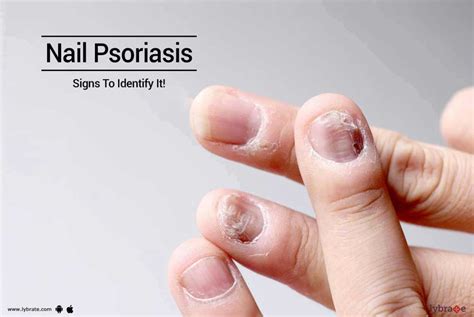 Nail Psoriasis Signs To Identify It By Dr Manju Keshari Lybrate
